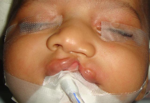 CLEFT